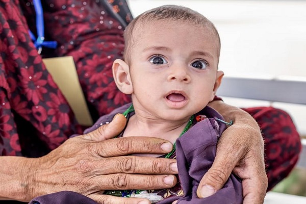 هشدار سازمان ملل نسبت به عواقب سوء تغذیه کودکان افغان هشدار سازمان ملل نسبت به عواقب سوء تغذیه کودکان افغان