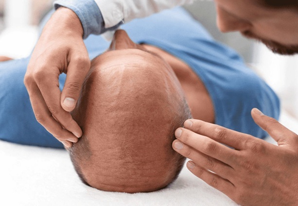 جدیدترین روش رویش مجدد موی سر