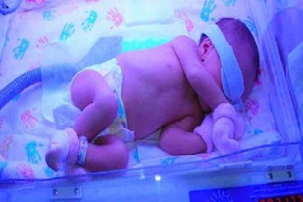 پنج شنبه/ زردی نوزاد و باورهای غلط آسیب‌زا به کبد کودکان